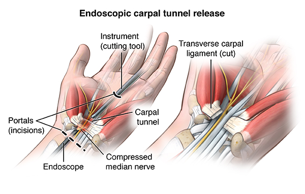 carpal tunnel surgery